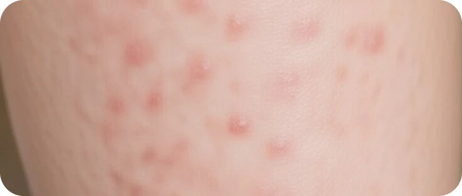 Fraisel Skin