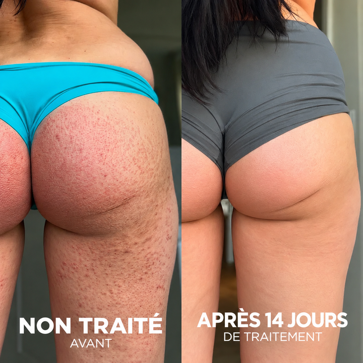 Complexe Triple-Acide Avancé pour Kératose Pilaire