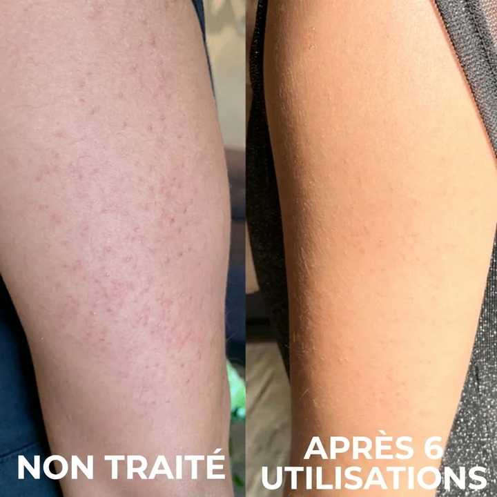 Complexe Triple-Acide Avancé pour Kératose Pilaire