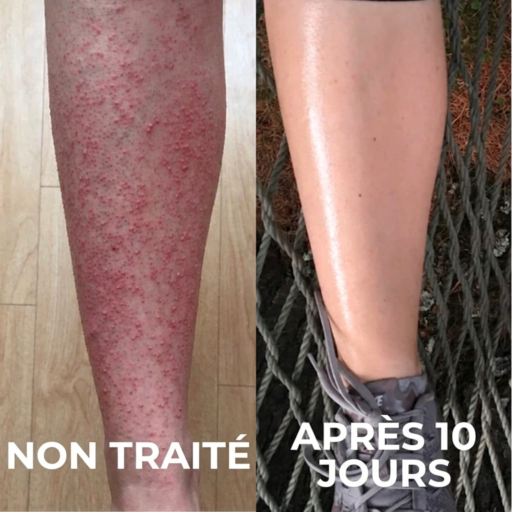 Complexe Triple-Acide Avancé pour Kératose Pilaire