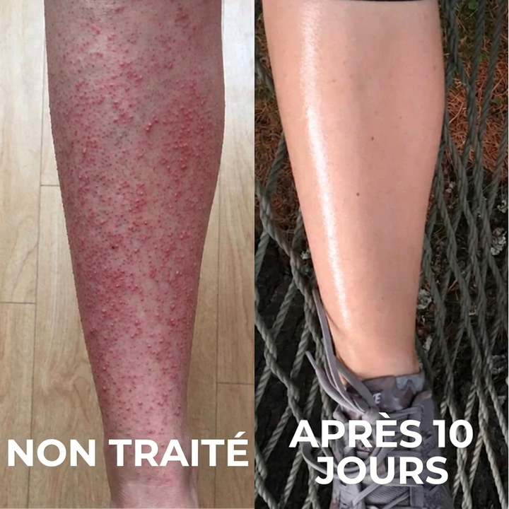 Complexe Triple-Acide Avancé pour Kératose Pilaire